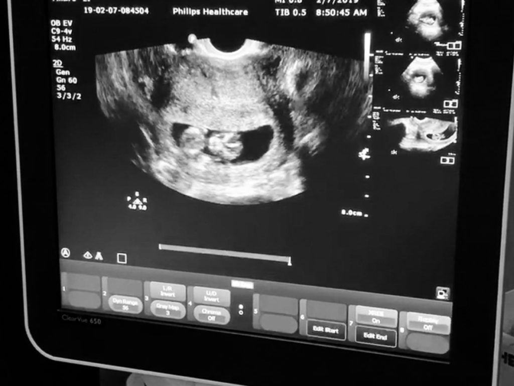 ultrasound picture - Felisa